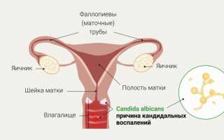 Грибок Кандида — что это и как лечить