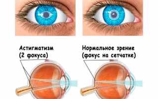 Особенности лазерной коррекции астигматизма