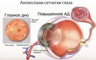 Cимптомы ангиоспазма сетчатки глаза, лечение и профилактика