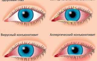 Причины и симптомы факосклероза хрусталика глаза