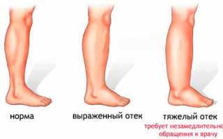 Отекают ноги у женщин