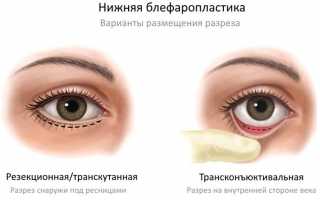Методы избавления от мешков под глазами и стоимость процедуры