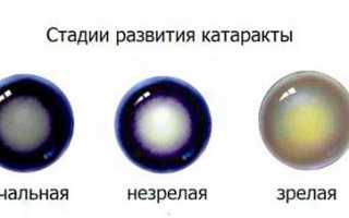 Народные средства при катаракте