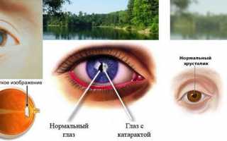 Зачем и как проводят ППЛК сетчатки