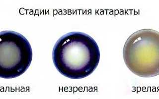 Операция при катаракте