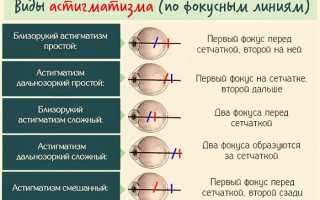 Причины гиперметропического астигматизма у детей