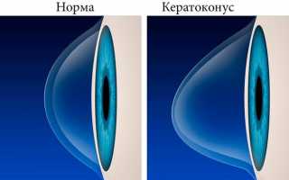 Этапы и проведение роговичного кросслинкинга