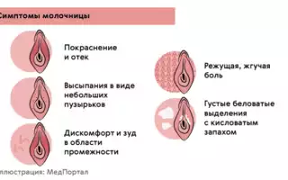 Молочница и зуд
