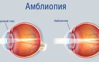 Особенности лечения нарушений эмметропии глаза