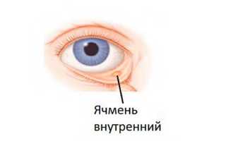 Особенности лечения внутреннего ячменя