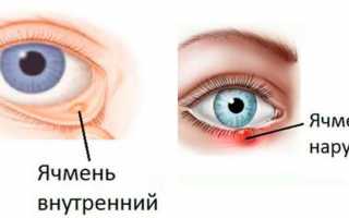 Ячмень – психосоматическая болезнь родом из детства