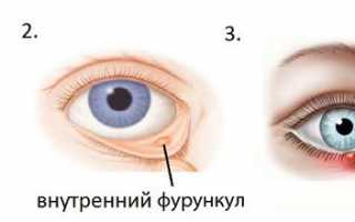 Причины появления чирья на глазу, симптомы, методы лечения и профилактика