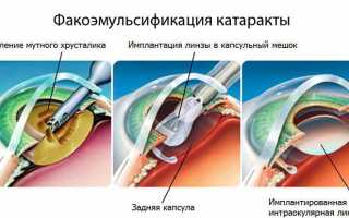 Причины, симптомы, лечение и профилактика катаракты