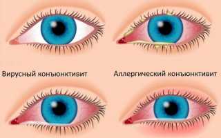 Лопнул сосуд в глазу: как бороться с патологией