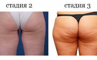 Боли при целлюлите — причины и лечение