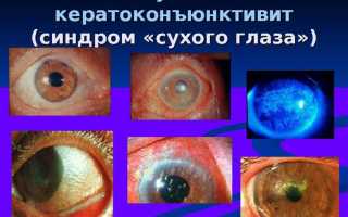 Инструкция по применению глазных капель Катионорм