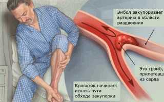 Тромбоз артерий нижних конечностей