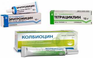 Как лечить конъюнктивит у ребёнка в домашних условиях