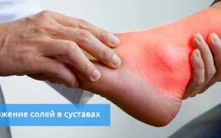 Отложение солей в стопе — лечение