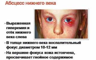 Абсцесс века — информация, которую важно знать каждому