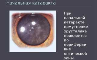 Начальная стадия катаракты