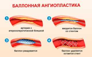 Ангиопластика — что это