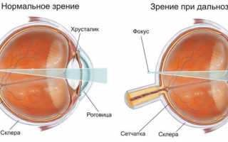 Метод лечения Фемто Супер Ласик