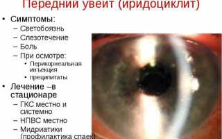 Причины, симптомы, диагностика и лечение неврита зрительного нерва