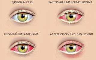 Как советует лечить конъюнктивит у детей доктор Комаровский