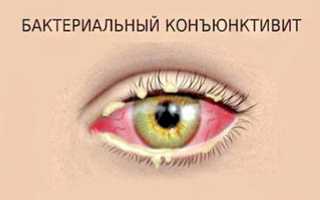 Причины, лечение и профилактика бактериального конъюнктивита