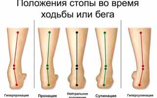 Пронация стопы