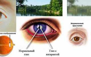 Причины возникновения осложнённой катаракты и способы борьбы с ней
