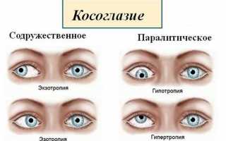 Причины сходящегося косоглазия и методы его коррекции