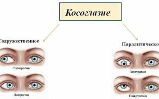 Причины и лечение косоглазия у новорождённых