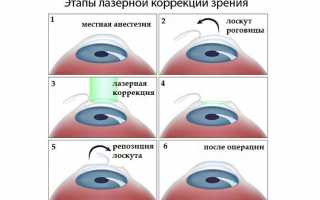 Астигматизм и катаракта