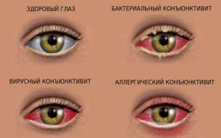 Патчи от синяков под глазами