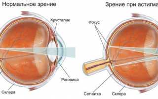 Блефароконъюнктивит глаз и его лечение