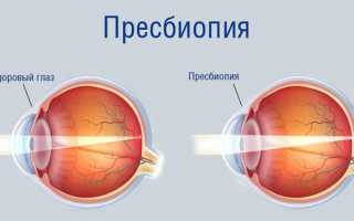 Как называется близорукость и дальнозоркость одновременно