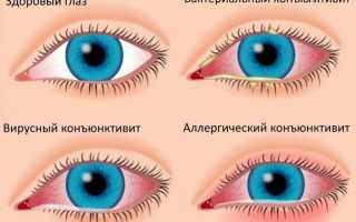 Составы для промывания глаз при конъюнктивите