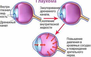 Терапия глаукомы глазными каплями Офтан Тимолол