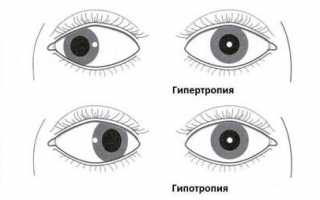 Причины и виды косоглазия у детей, методы лечения и профилактика