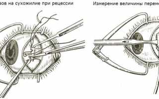 Особенности исправления косоглазия у взрослых