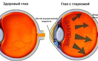 Разрешено ли рожать в линзах