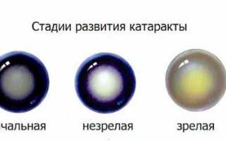 Диагностика и методы лечения перезрелой катаракты