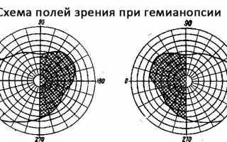 Механизм развития и коррекция гемианопсии