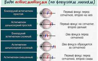 Причины врождённого астигматизма —  лечение и методы коррекции