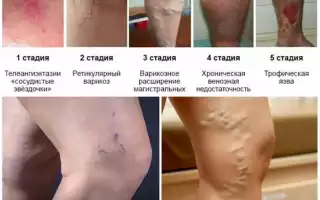 Ретикулярный варикоз