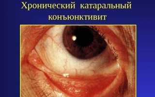Причины, симптомы и лечение вирусного конъюнктивита