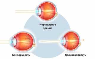 Что такое плохое зрение