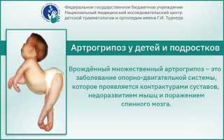 Артрогрипоз